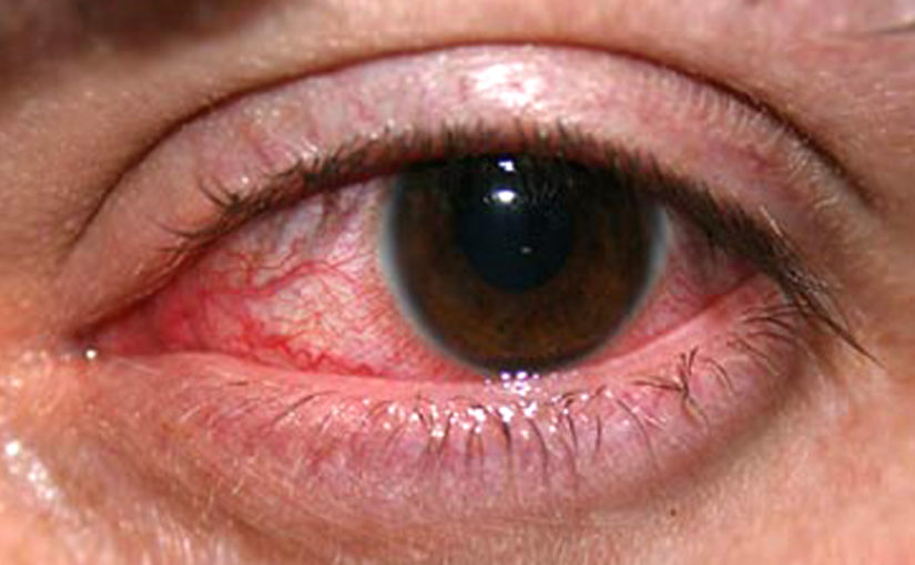 অ্যালার্জিক কনজাংটিভাইটিস