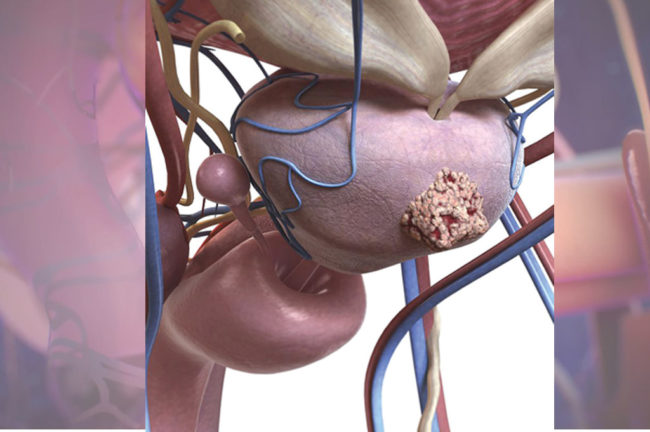 প্রস্টেট ক্যানসার
