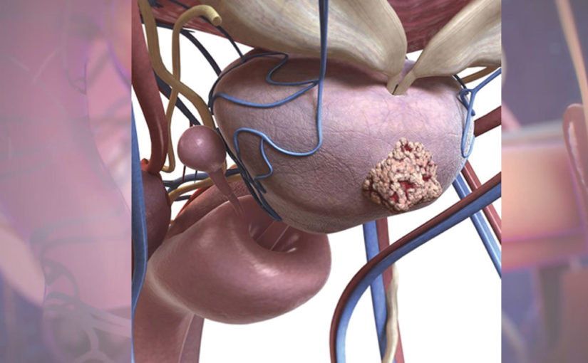 প্রস্টেট ক্যানসার