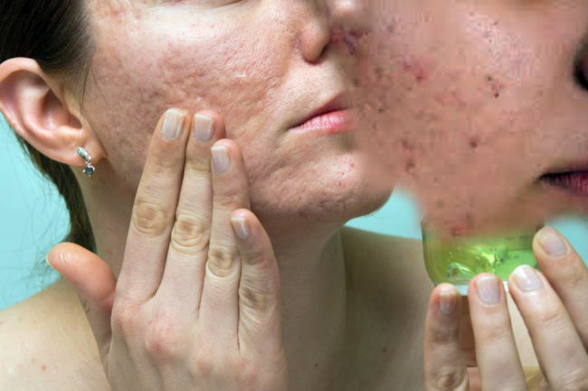 ব্রণর মোকাবিলা করতে