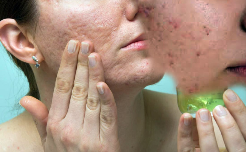 ব্রণর মোকাবিলা করতে