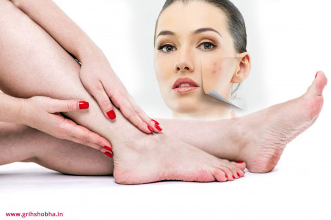 খুশকির সমস্যা এবং গোড়ালির সমস্যায় সমাধানের উপায়