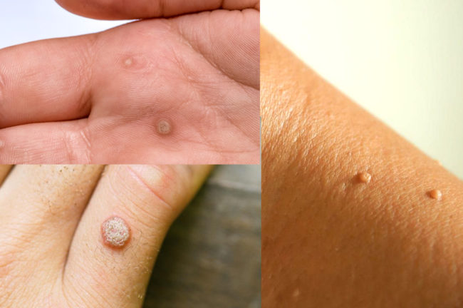Article about body warts