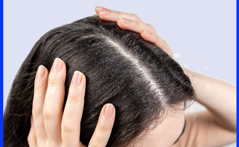 খুশকির জন্য মাথার স্ক্যাল্পে চুলকানি  বেড়েছে