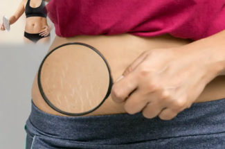 Stretch marks due to weight loss