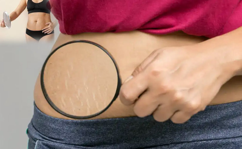 পেট এবং থাইয়ের কাছে স্ট্রেচ মার্কস হয়ে গেছে