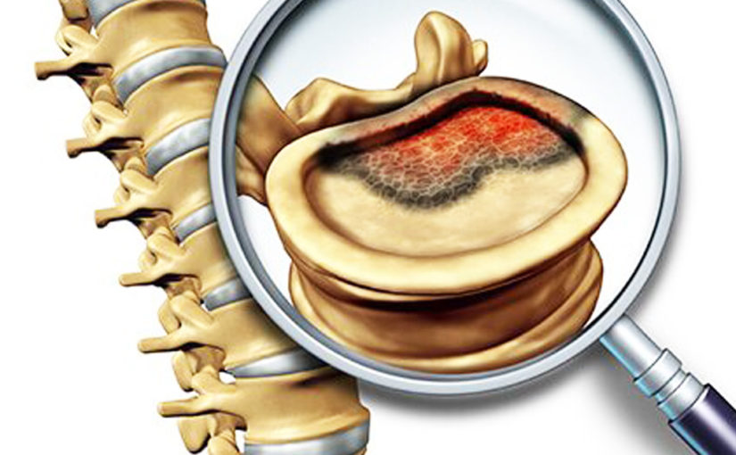 বোন ও সফট টিস্যুর ক্যান্সারের জন্য লিম্ব স্পেয়ারিং সার্জারি