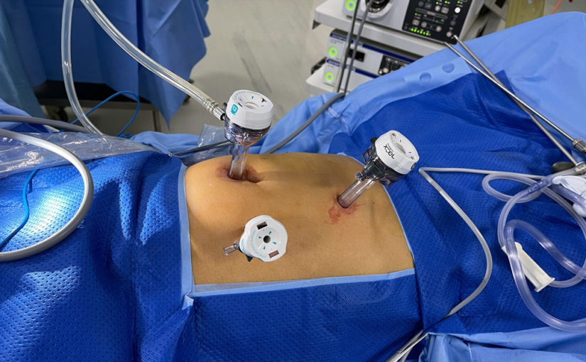 কীহোল কোলোনিক সার্জারি