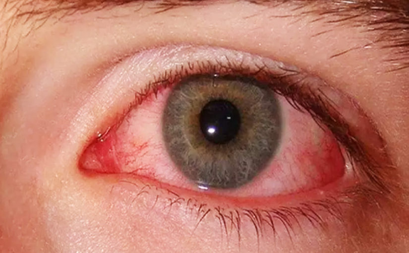 আই-ফ্লু বা কনজাংক্টিভাইটিস—সতর্কতা এবং সঠিক চিকিৎসা