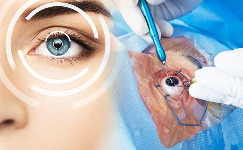 লেজার ক্যাটারাক্ট সার্জারি