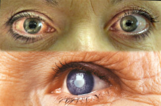 Glaucoma problems and proper care and treatment