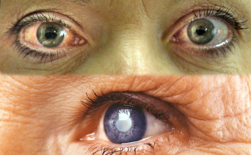 ঠাকুরদা’র গ্লুকোমা ছিল, আমারও কি গ্লুকোমা হওয়ার ভয় আছে?