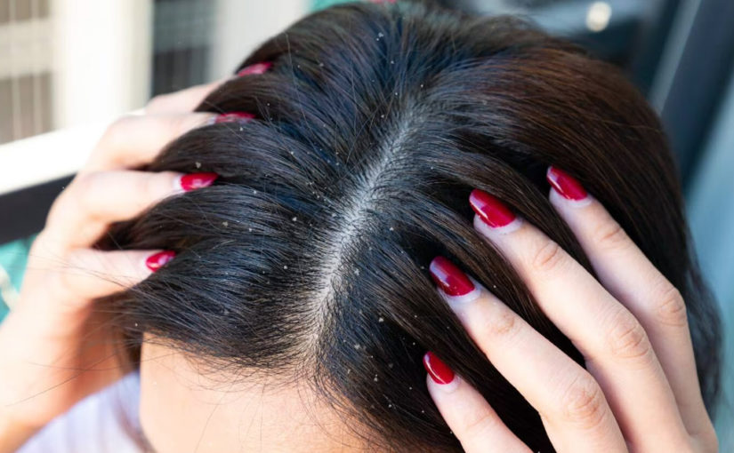 খুশকির সমস্যা থেকে মুক্তি পাব কীভাবে?