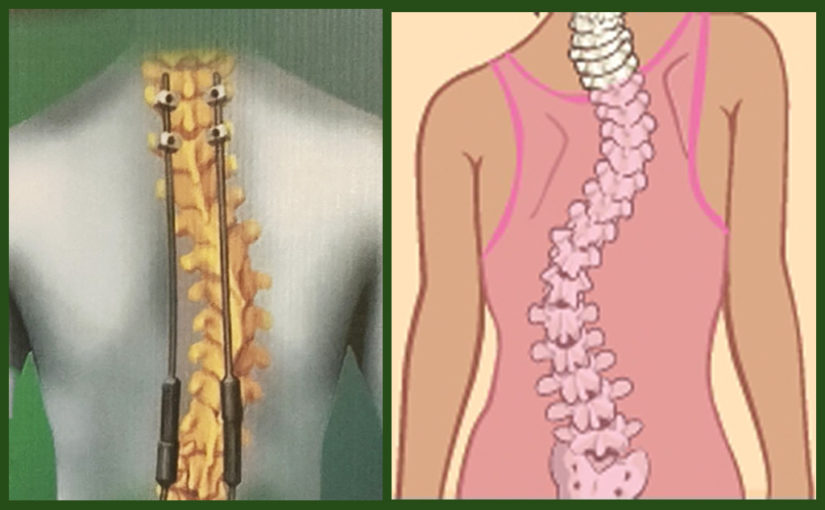 মেরুদণ্ড বিকৃতির চিকিৎসায় অভিনব উদ্যোগ ‘অপারেশন স্ট্রেইট স্পাইন’