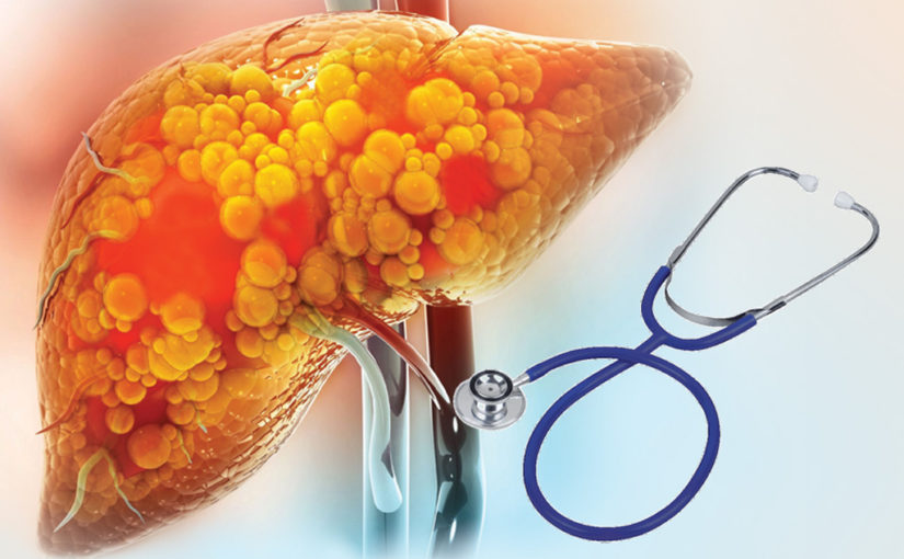 ফ্যাটি লিভার এবং সঠিক চিকিৎসা