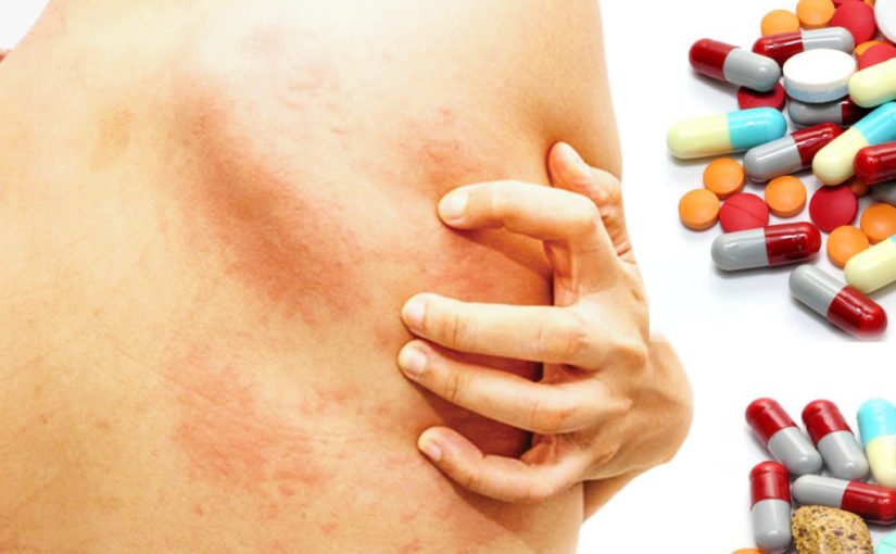 Drug Allergy-র সমস্যা এবং সতর্কতা