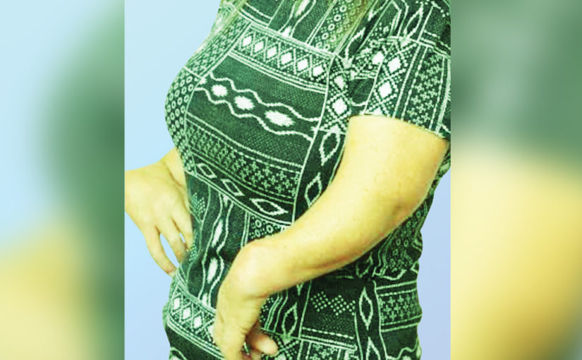 বিরল অসুখ— ফোকোমেলিয়া