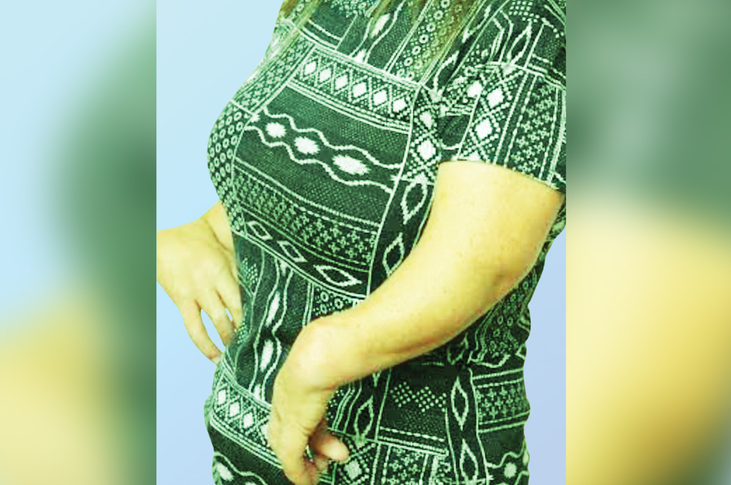 বিরল অসুখ— ফোকোমেলিয়া