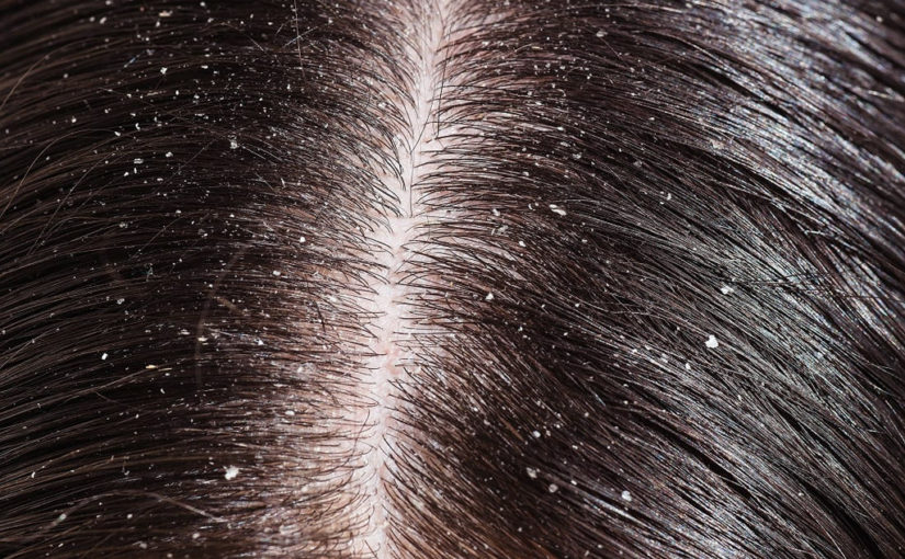 খুশকির সমস্যা এবং সমাধানের উপায়