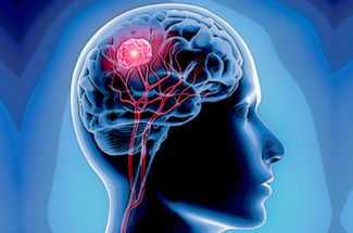 ব্রেন টিউমার এবং আধুনিক চিকিৎসা