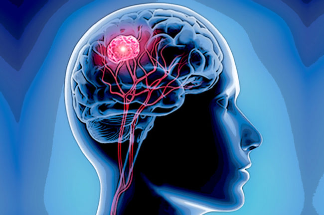 ব্রেন টিউমার এবং আধুনিক চিকিৎসা