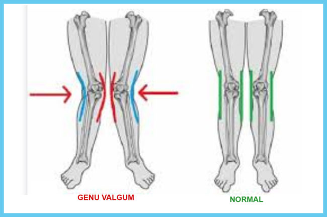 জেনু ভালগাম সমস্যায় পর্যবেক্ষণ এবং চিকিৎসার সঠিক উপায়