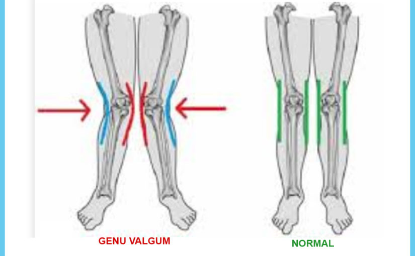জেনু ভালগাম সমস্যায় পর্যবেক্ষণ এবং চিকিৎসার সঠিক উপায়